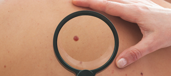 Dermatologist examines a mole